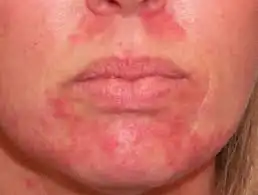 How Does Betamethasone Work How Does Betamethasone Work