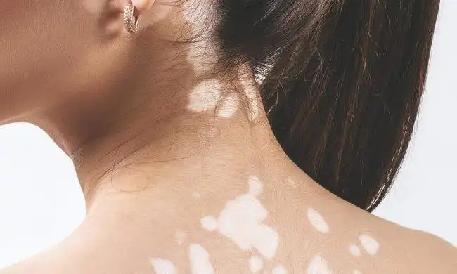 Application of Monobenzone Application of Monobenzone